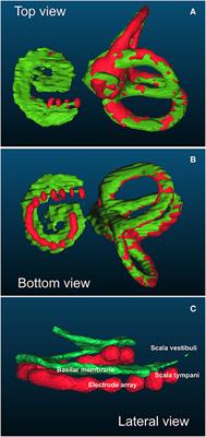 Restoration of High Frequency Auditory Perception After Robot-Assisted or Manual Cochlear Implantation in Profoundly Deaf Adults Improves Speech Recognition